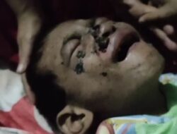 Bocah Penderita Kanker Kulit di Cibeber Ingin Sembuh dan Sekolah