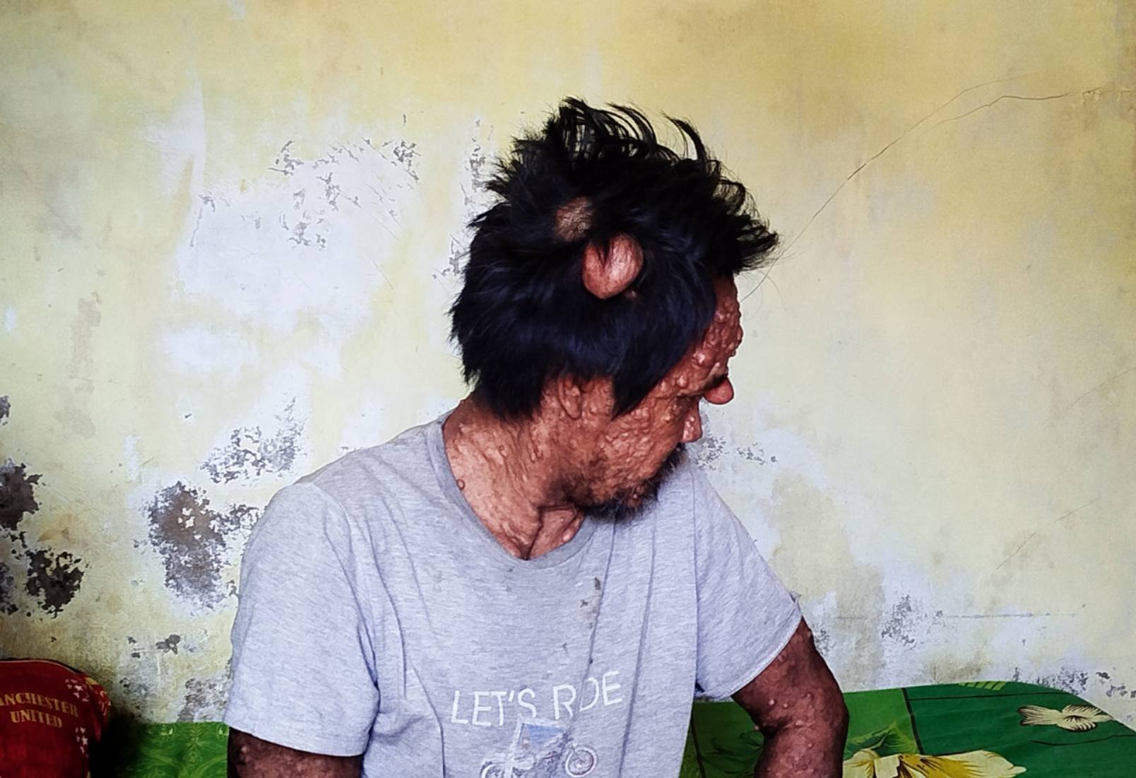 Warga Cianjur penderita tumor jinak hidup seorang diri setelah ditinggalkan istri.