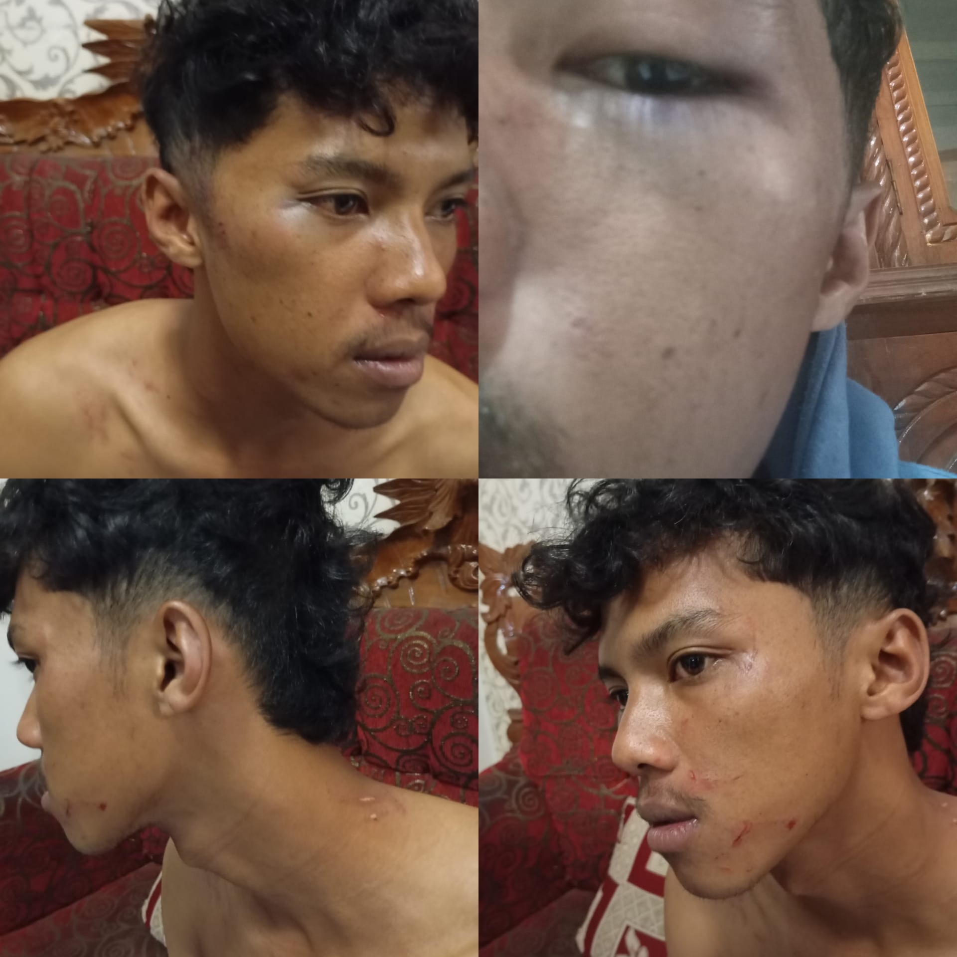 Teks: Korban pengeroyokan di Cianjur mengalami luka memar di wajah dan lecet di tubuh.